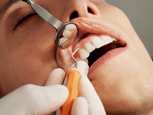 Smile Makeover
